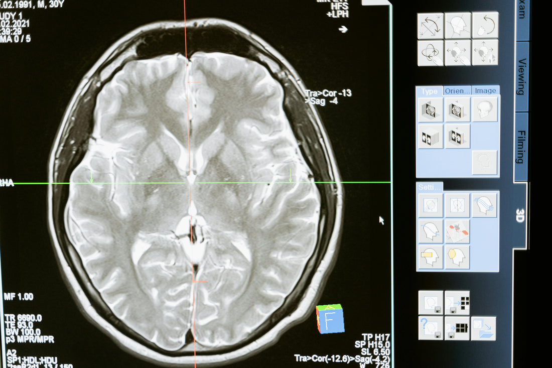 How Stress Affects the Brain and What Can Help