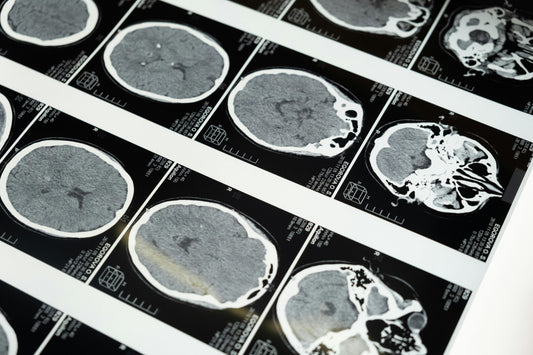 How a New Diabetes Drug Could Help Protect Your Brain