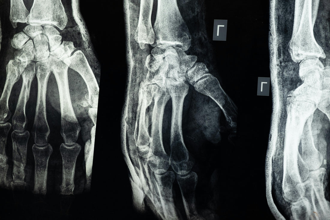Does Eating More Protein Harm Your Bones?