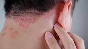 Hidden Link Between Sleep and Psoriasis Severity
